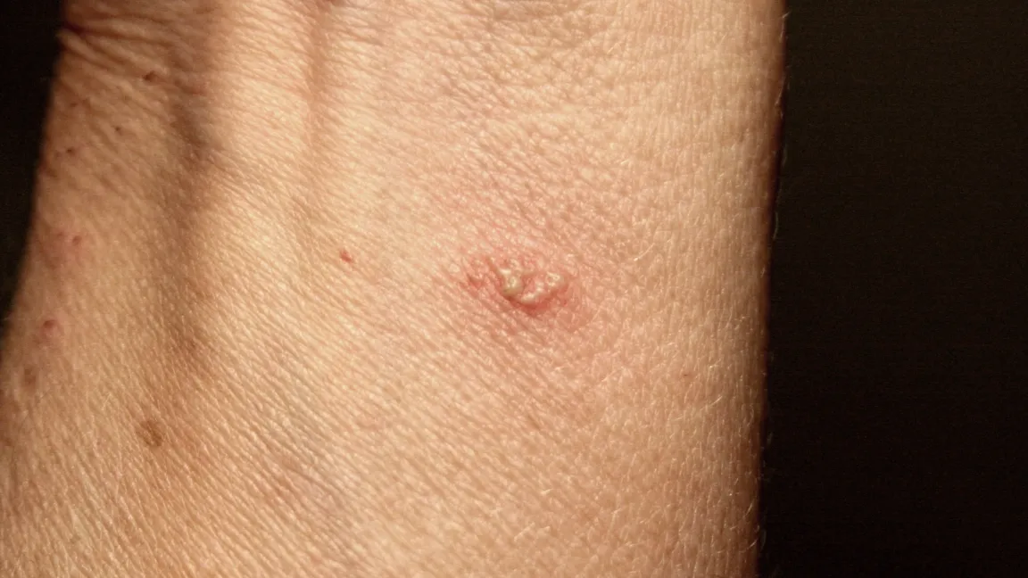 Kleine Brandblase durch eine Photodermatose. Foto: Heinrich Beltz