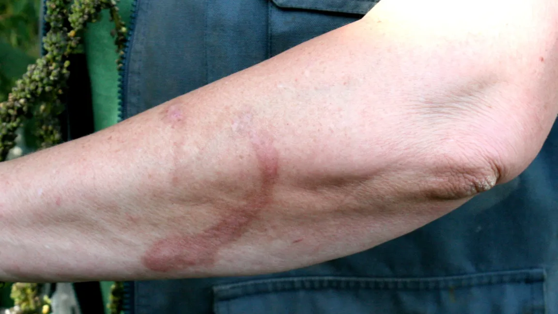 Hautverfärbungen durch eine Photodermatose. Foto: Heinrich Beltz