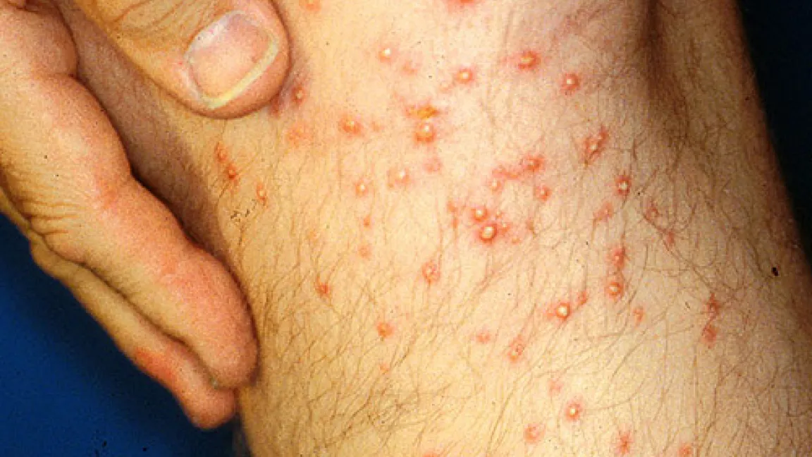 In weniger als 10 Sekunden wurde ein unvorsichtiger Wissenschaftler über 250 x ins Bein gebissen.
Quelle: USDA